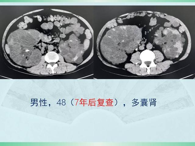 多囊肾是一种常染色体显性遗传病,发病