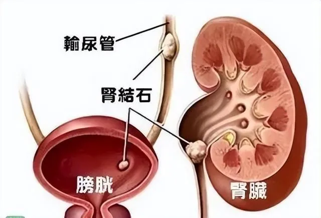 痉挛,急性梗阻,从而引发肾脏区域的剧烈绞痛,这种疼痛往往难以忍受的